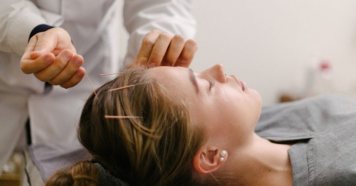 How Many Acupuncture Sessions Are Needed for Noticeable Migraine&nbsp;Relief